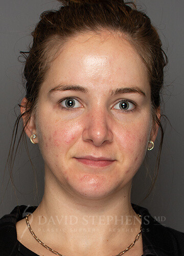 Rhinoplasty-Patient-10 | After Rhinoplasty