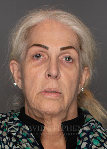 Rhinoplasty-Patient-11 | After Rhinoplasty