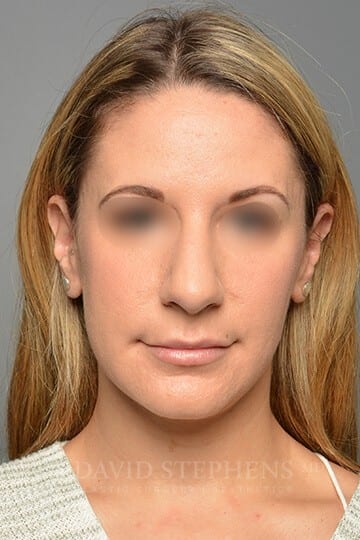 Rhinoplasty before image.
