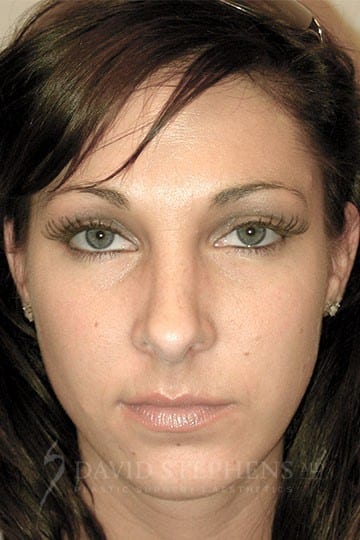 Rhinoplasty-Patient-01 | After Rhinoplasty