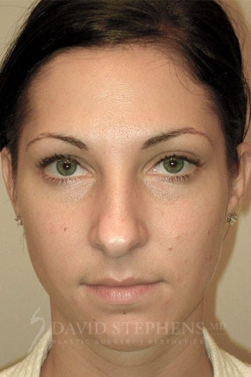 Rhinoplasty-Patient-01 | Before Rhinoplasty