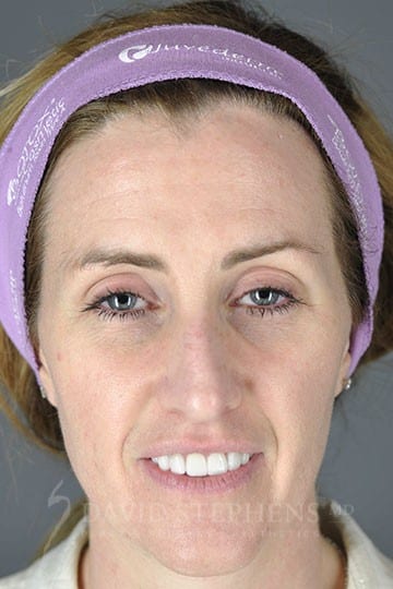 Rhinoplasty-Patient-02 | Before Rhinoplasty