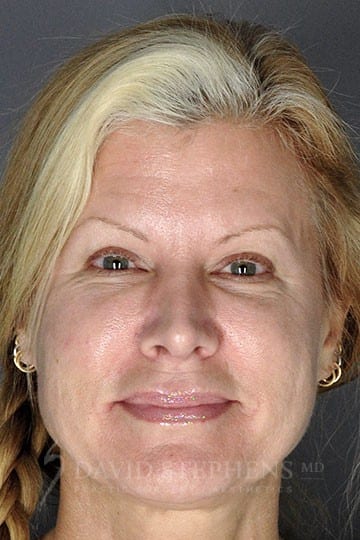 Rhinoplasty-Patient-03 | After Rhinoplasty