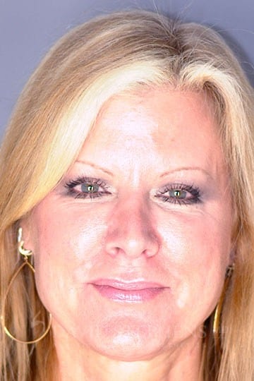 Rhinoplasty-Patient-03 | Before Rhinoplasty