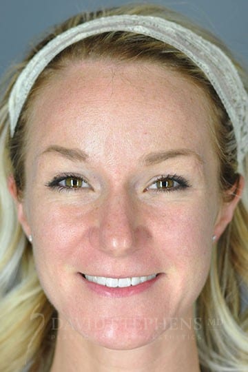 Rhinoplasty-Patient-04 | Before Rhinoplasty