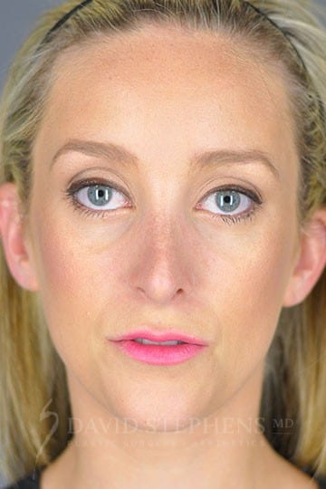 Rhinoplasty-Patient-05 | After Rhinoplasty