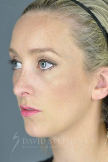 Rhinoplasty - Actual Patient Results - After - 2