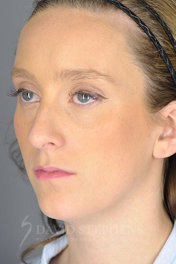 Rhinoplasty - Actual Patient Results - Before - 2