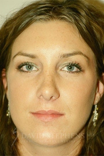 Rhinoplasty-Patient-06 | After Rhinoplasty