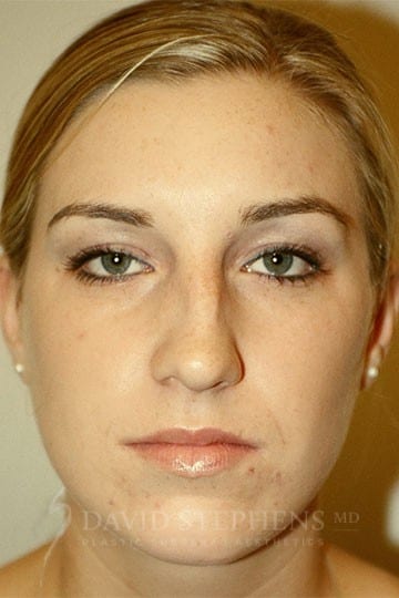Rhinoplasty-Patient-06 | Before Rhinoplasty