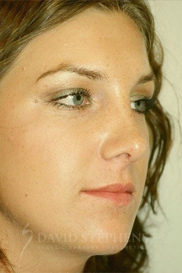 Rhinoplasty - Actual Patient Results - After - 2