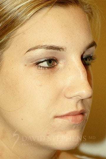 Rhinoplasty - Actual Patient Results - Before - 2