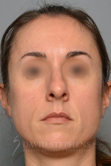 Rhinoplasty-Patient-07 | Before Rhinoplasty