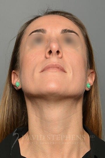 Rhinoplasty-Patient-08 | After Rhinoplasty