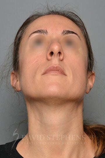 Rhinoplasty-Patient-08 | Before Rhinoplasty