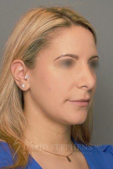 Rhinoplasty-Patient-09 | After Rhinoplasty