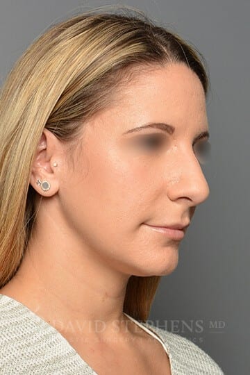 Rhinoplasty-Patient-09 | Before Rhinoplasty