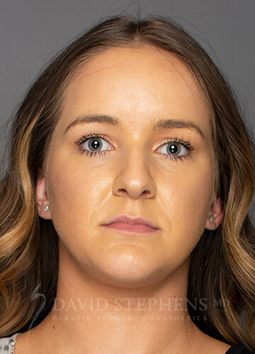 Rhinoplasty-Patient-10 | Before Rhinoplasty