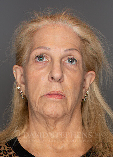 Rhinoplasty-Patient-11 | Before Rhinoplasty