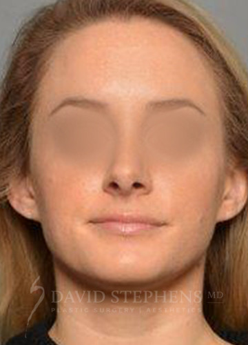 Rhinoplasty-Patient-12 | After Rhinoplasty