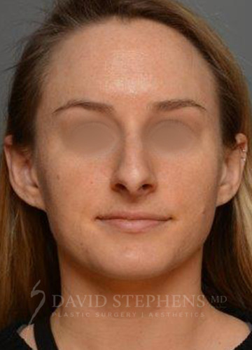 Rhinoplasty-Patient-12 | Before Rhinoplasty