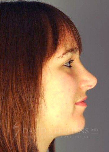 Rhinoplasty-Patient-13 | After Rhinoplasty