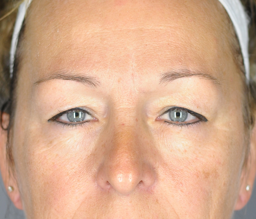 Case--2370 | Before Blepharoplasty
