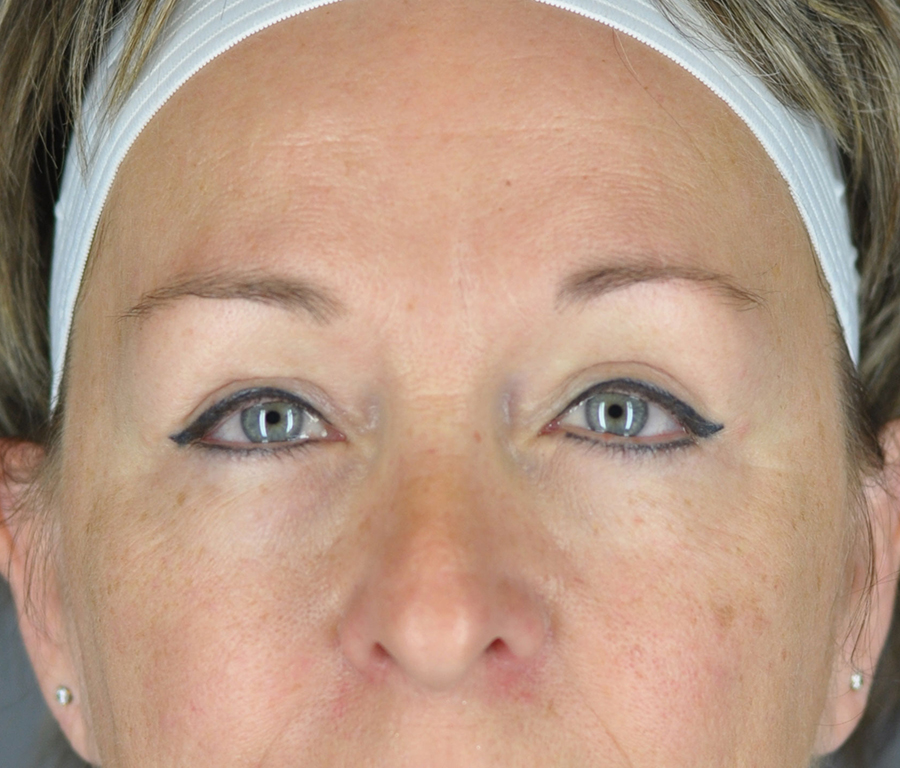 Case--2370 | After Blepharoplasty
