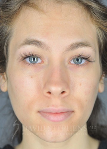 VI-Peel-Patient-01 | After VI Peel