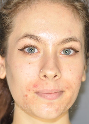 VI-Peel-Patient-01 | Before VI Peel